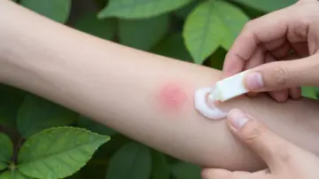 Defeating the buzz: Your guide to mosquito bite relief and prevention
