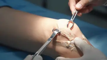 Rethinking Knee Surgery: Why Common Procedures May Do More Harm Than Good